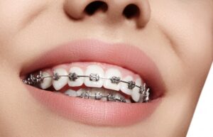 Orthodontic Treatments